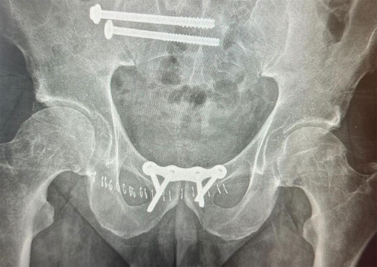 Cirurgia prende os ossos de Coco Nogales e agora ele tem uma longa recuperação pela frente