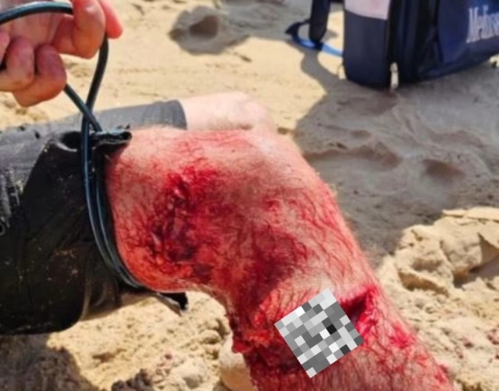 perna do surfista atacado na Ponta do Ouro de Maputo, em Moçambique.