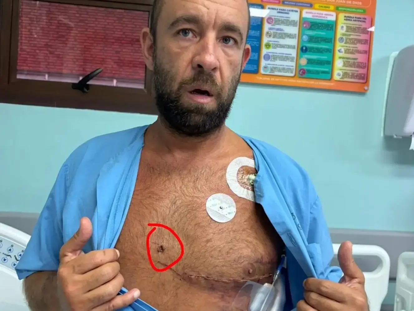 Fabiano Duarte da Costa, surfista brasileiro atingido por um peixe-agulha enquanto surfava em Pavones, na Costa Rica.